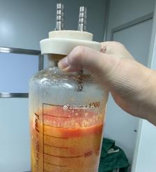 南昌水动力吸脂手术要做多久？